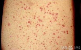 血小板减少的症状,症状解析与应对策略