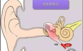 急性中耳炎症状,疼痛、发热、听力下降的警示信号